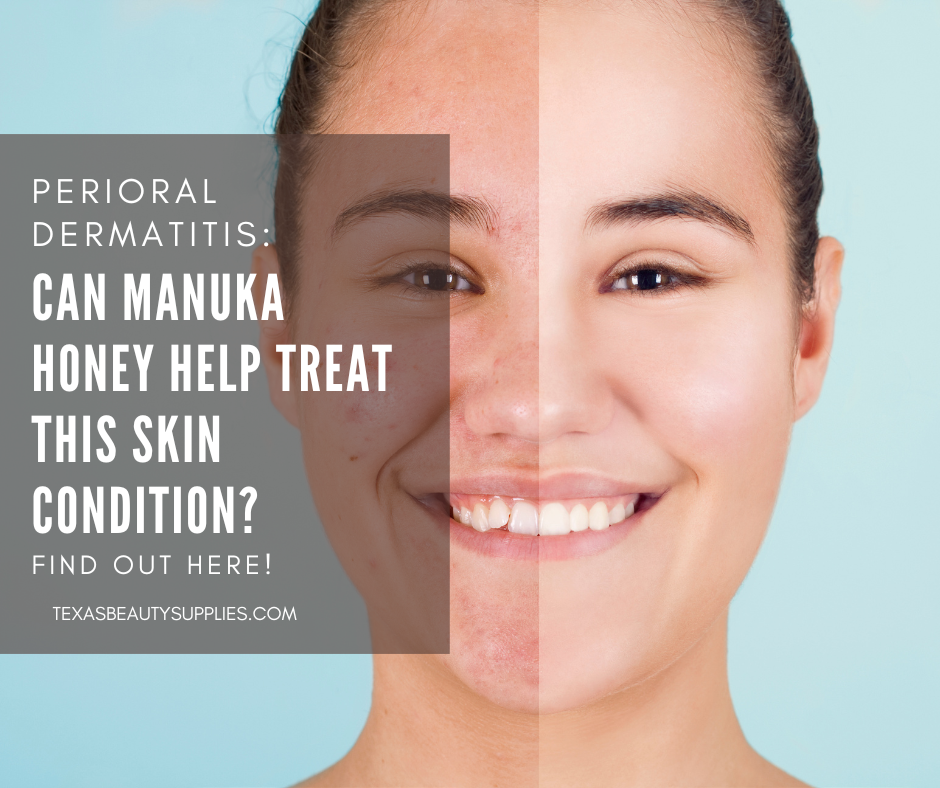 perioral dermatitis manuka honey